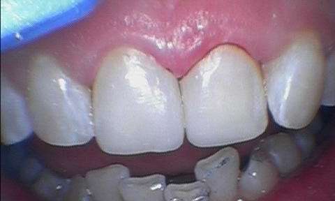 Patient teeth after composite build-ups