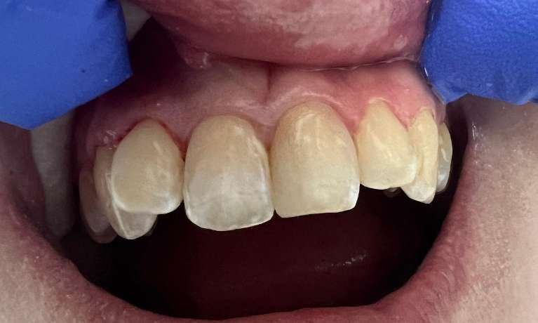 Patient teeth after composite fillings
