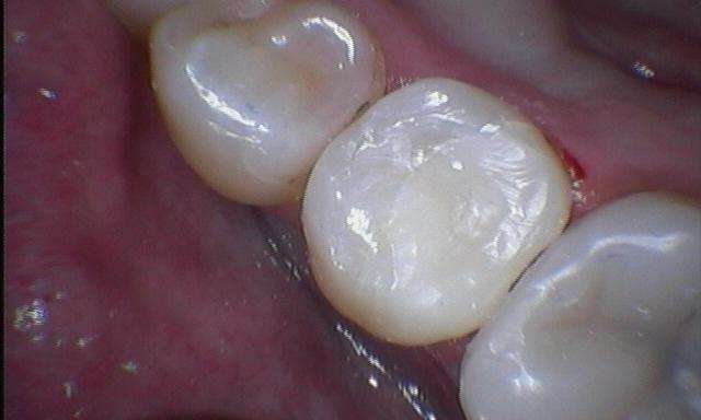 Decayed-Tooth-After-Image