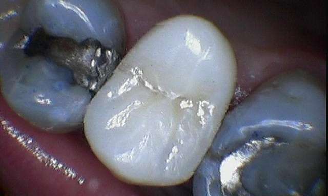 Dental-Crown-After-Image