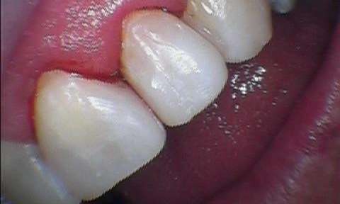 Dental-Filling-on-Front-Tooth-After-Image