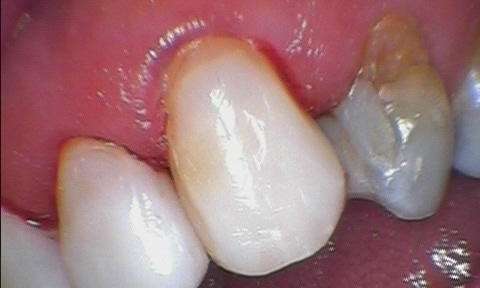 Patient after receiving a front tooth dental filling | Raymond Terrace dentist
