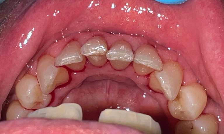 A patient's teeth after receiving a dental clean in Kurri Kurri