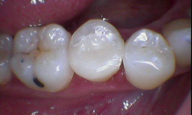 Restoration-of-a-Heavily-Decayed-Tooth-After-Image