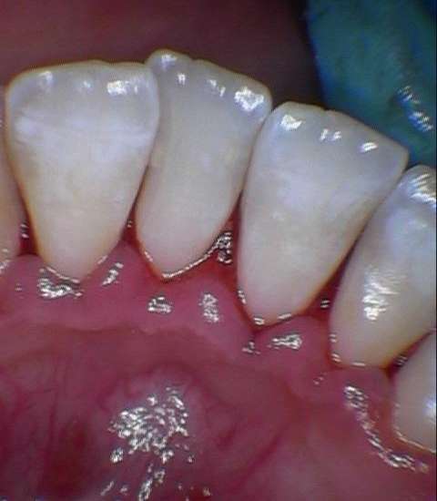 Severe-Gingivitis-After-Image