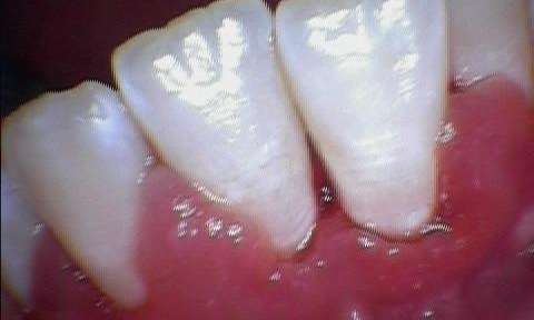 Patient after calculus was removed, and gingivitis addressed