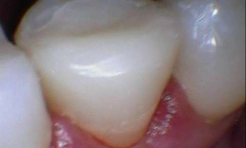 Picture of a patient tooth after receiving a dental crown at Everbright Dental