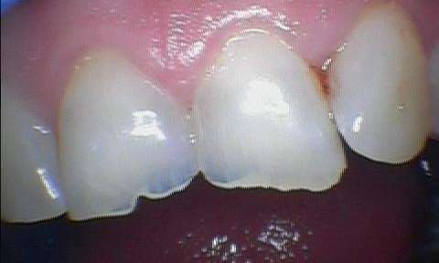 A patient with worn-down teeth from grinding, ageing, or damage.