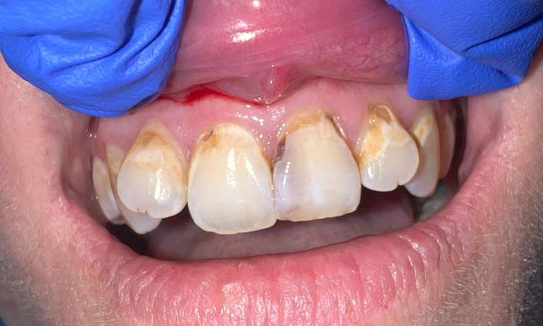 Patient teeth before composite fillings