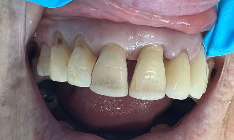A patient's teeth gaps before getting composite veneers