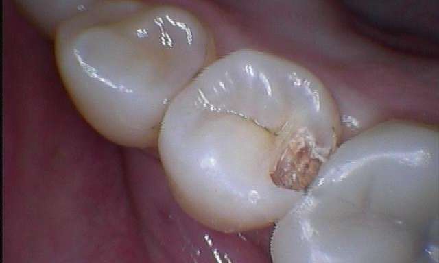Decayed-Tooth-Before-Image