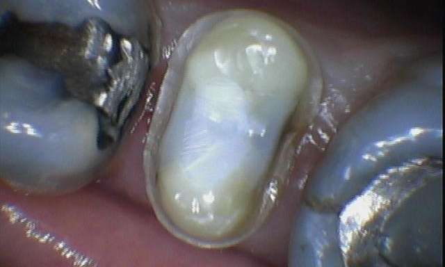 Dental-Crown-Before-Image