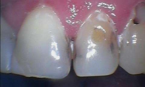 Dental-Filling-on-Front-Tooth-Before-Image
