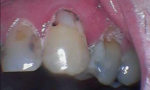 Patient before front tooth dental filling | Kurri Kurri dentist