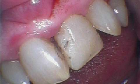 Patient with a cavity affecting their oral health