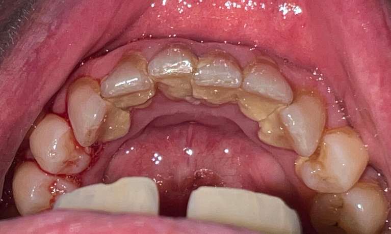 A patient before receiving a dental clean in Kurri Kurri