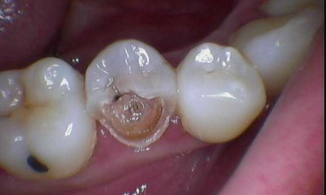 Restoration-of-a-Heavily-Decayed-Tooth-Before-Image