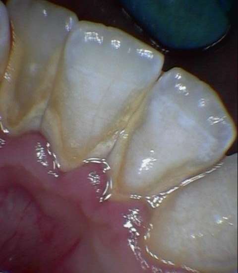 Severe-Gingivitis-Before-Image