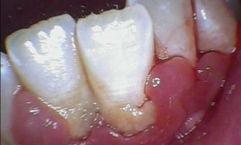Patient with gingivitis and calculus