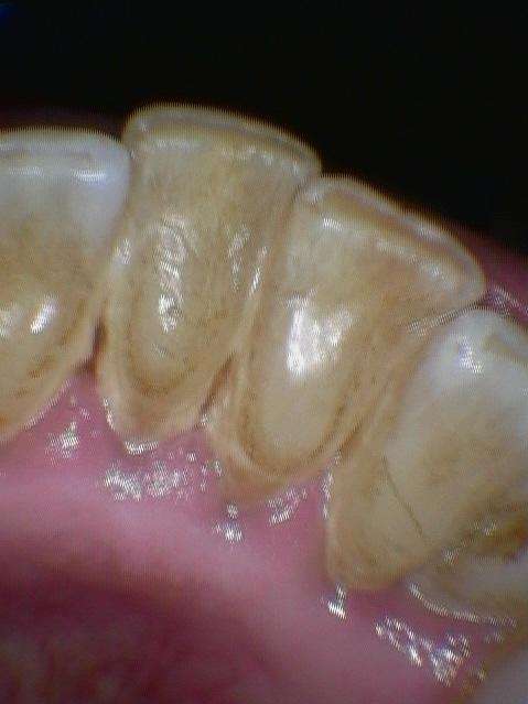 Patient teeth before getting a dental clean in Raymond Terrace