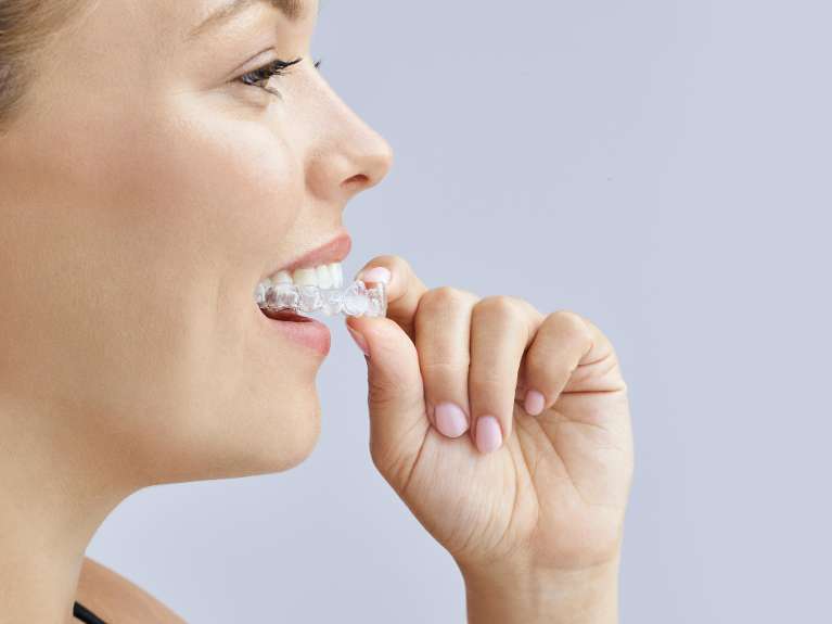 A woman putting in her clear aligners